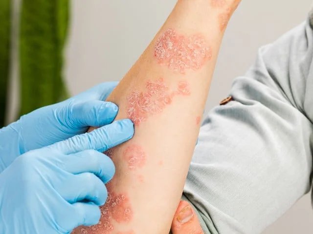 Dermatolojik Hastalıklar